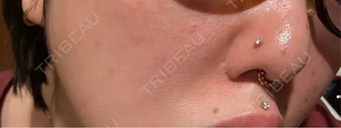 マイクロボトックス Natural Skin Clinic 自由ヶ丘院 DAY 1 メイン用