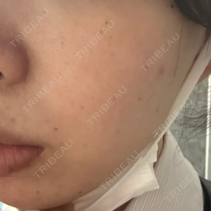 ルメッカ ルラ美容クリニック 千葉院 / ルラスキンクリニック 千葉院 DAY 4 メイン用