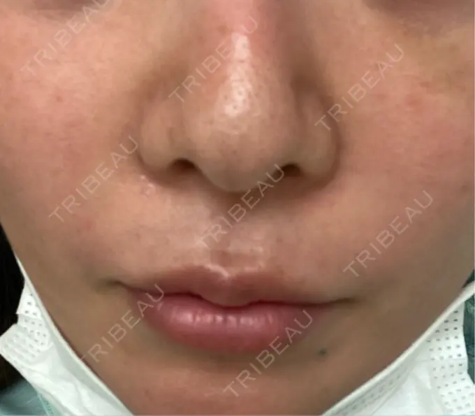 ヒアルロン酸注入（目の下） / ヒアルロン酸注入（鼻翼基部） 湘南美容クリニック 博多院 DAY 10 メイン用