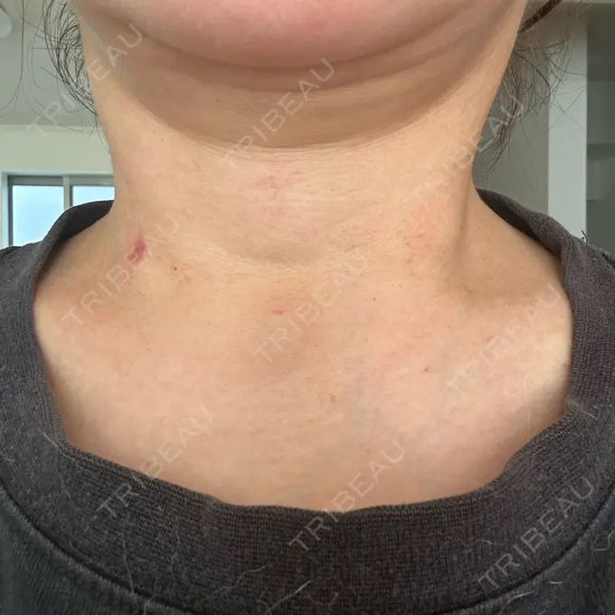 ヒアルロン酸注入（首） MKクリニック 銀座院 AFTER メイン用