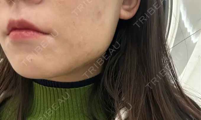 ボトックス（エラ・小顔） フィラークリニック 名古屋栄院 AFTER メイン用