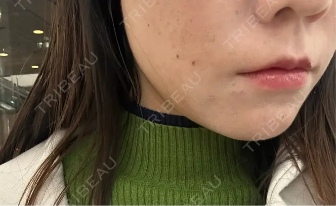 ボトックス（エラ・小顔） フィラークリニック 名古屋栄院 DAY 12 メイン用