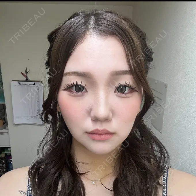 クマ治療 / 脂肪吸引（顔） / ヒアルロン酸注入（涙袋） / ヒアルロン酸注入（目の下） ネビュラクリニック 東京錦糸町院 DAY 7 メイン用