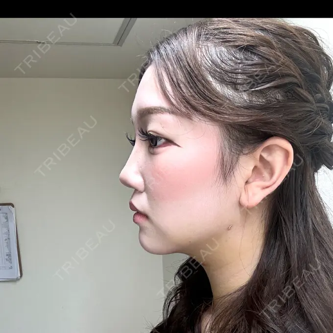 クマ治療 / 脂肪吸引（顔） / ヒアルロン酸注入（涙袋） / ヒアルロン酸注入（目の下） ネビュラクリニック 東京錦糸町院 DAY 7 メイン用