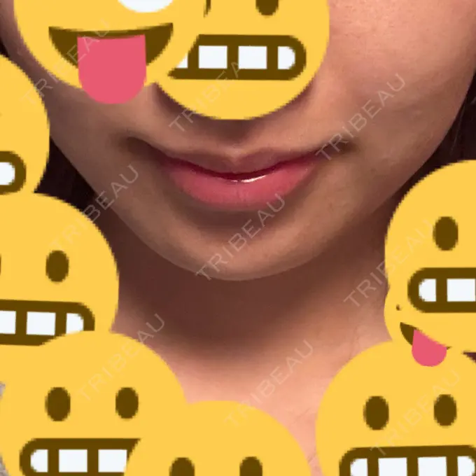 ボトックス（エラ・小顔） / ボトックス（首） DMTC CLINIC 渋谷院 AFTER メイン用