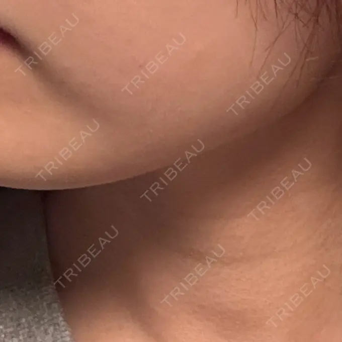 ボトックス（エラ・小顔） / ボトックス（首） DMTC CLINIC 渋谷院 DAY 14 メイン用