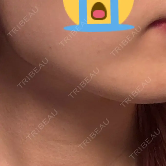 ボトックス（エラ・小顔） / ボトックス（首） DMTC CLINIC 渋谷院 DAY 14 メイン用