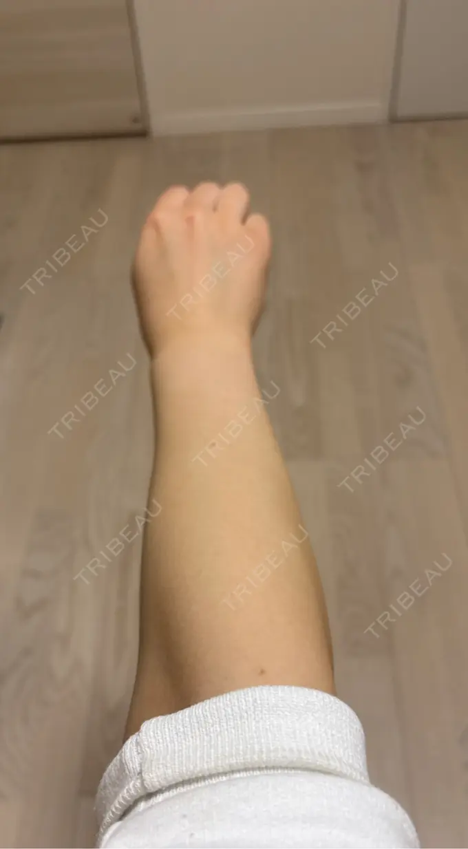 医療脱毛（全身） ダビデクリニック渋谷 DAY 2 メイン用