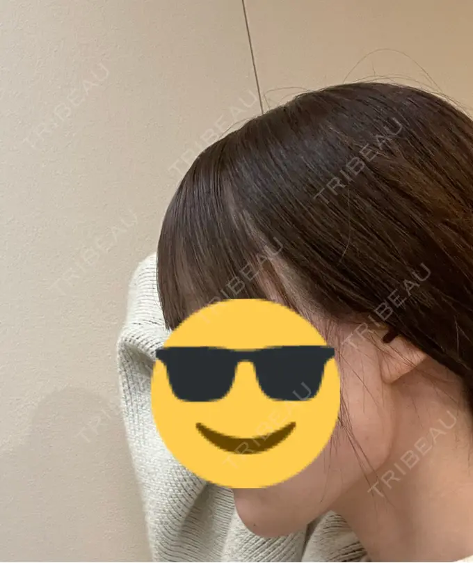 ヒアルロン酸注入（あご） / ボトックス（エラ・小顔） / ボトックス（口角） DMTC CLINIC 日本橋院 DAY 0 メイン用