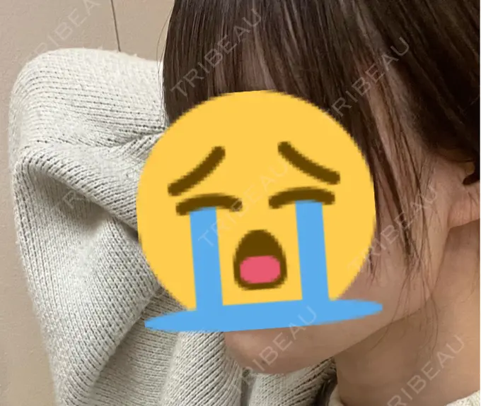 ヒアルロン酸注入（あご） / ボトックス（エラ・小顔） / ボトックス（口角） DMTC CLINIC 日本橋院 DAY 0 メイン用