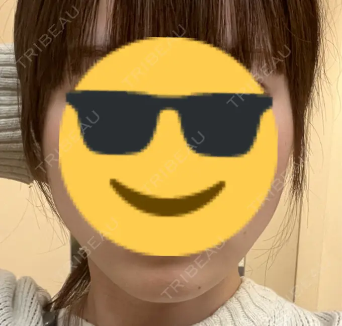 ヒアルロン酸注入（あご） / ボトックス（エラ・小顔） / ボトックス（口角） DMTC CLINIC 日本橋院 DAY 0 メイン用