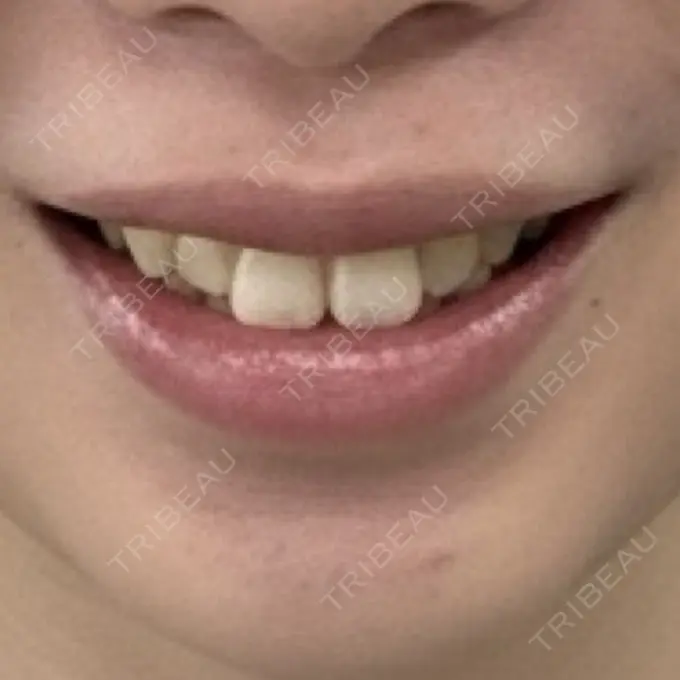 医療脱毛（顔） 日本美容・医療クリニック 六本木院 DAY 3 メイン用