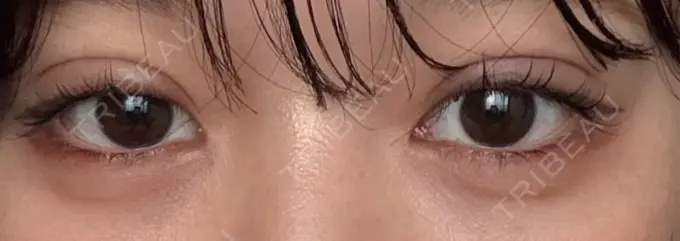 二重埋没 恵聖会クリニック 京橋院 DAY 6 メイン用