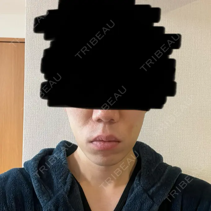 糸リフト / 脂肪吸引（顔） 東京ココセランクリニック DAY 2 メイン用