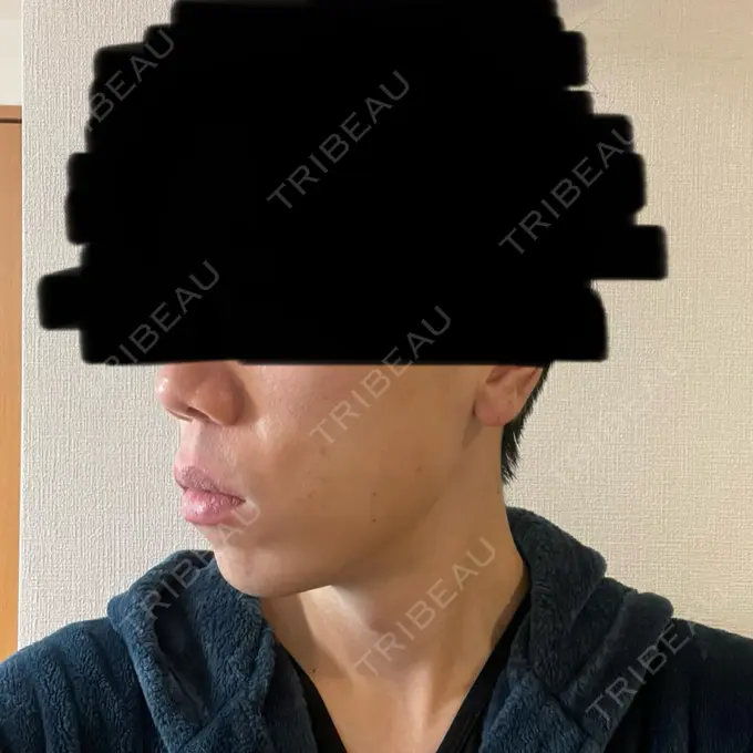 糸リフト / 脂肪吸引（顔） 東京ココセランクリニック DAY 2 メイン用