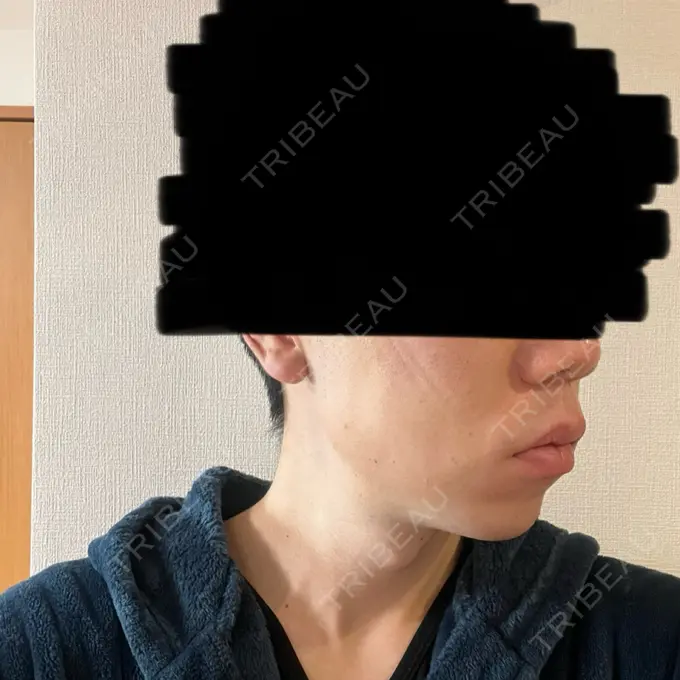 糸リフト / 脂肪吸引（顔） 東京ココセランクリニック DAY 2 メイン用