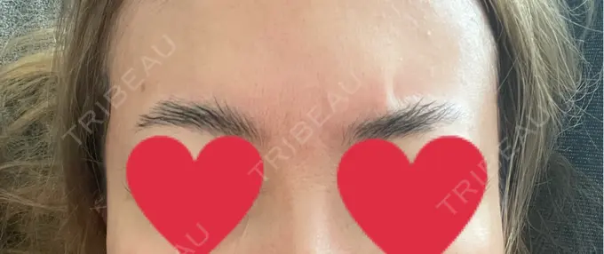 ボトックス（あご） / ボトックス（口角） / ボトックス（眉間） / ボトックス（目尻） / ボトックス（額） / ボトックス（人中） / ボトックス（ガミースマイル） DMTC CLINIC 渋谷院 DAY 5 メイン用