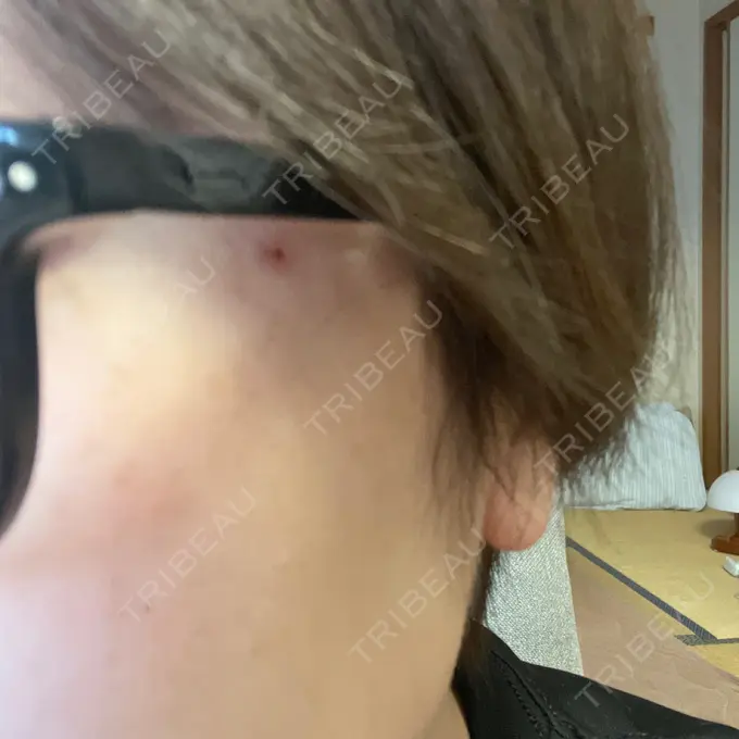 光治療（フォトフェイシャルなど） トラスト美容クリニック 銀座院 DAY 5 メイン用