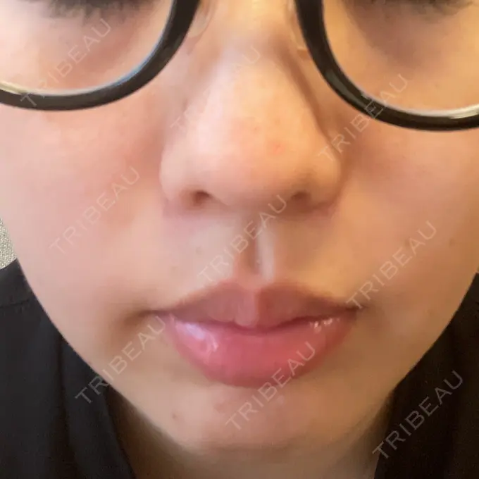 光治療（フォトフェイシャルなど） トラスト美容クリニック 銀座院 DAY 6 メイン用