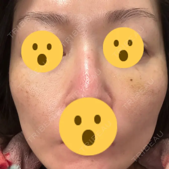 糸リフト SK新宿歌舞伎町美容外科・歯科 DAY 11 メイン用