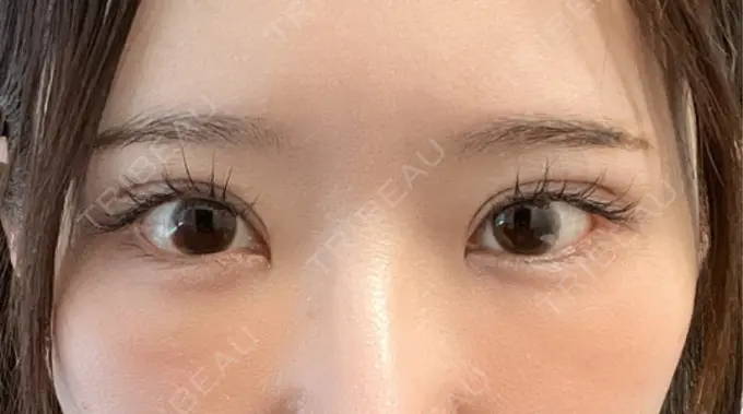 クマ治療 / 下まぶたの脂肪取り / 脂肪注入（目の下） ルラ美容クリニック 渋谷本院 DAY 7 メイン用