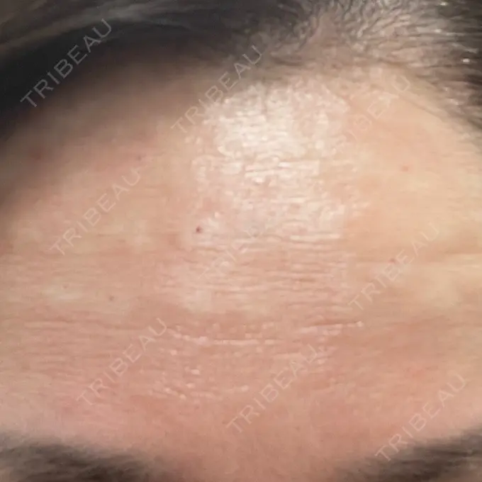 ボトックス（エラ・小顔） / マイクロボトックス ルラ美容クリニック 岐阜院 DAY 0 メイン用