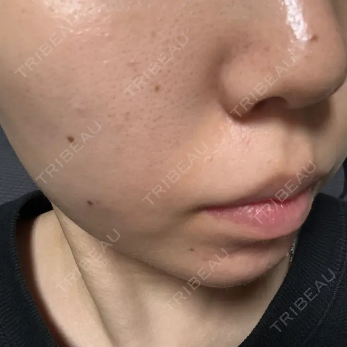 ピーリング（ニキビ・毛穴） Sea Sail Beauty Clinic DAY 14 メイン用