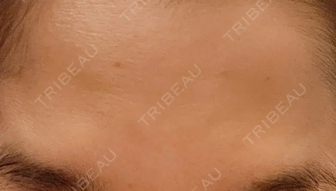 ボトックス（眉間） / ボトックス（目尻） / ボトックス（額） DMTC美容皮膚科 大宮院 DAY 14 メイン用