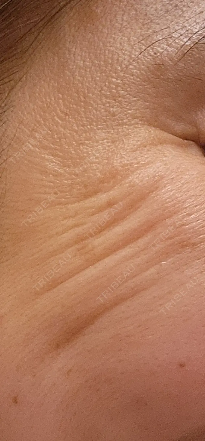 ボトックス（眉間） / ボトックス（目尻） / ボトックス（額） DMTC美容皮膚科 大宮院 DAY 14 メイン用