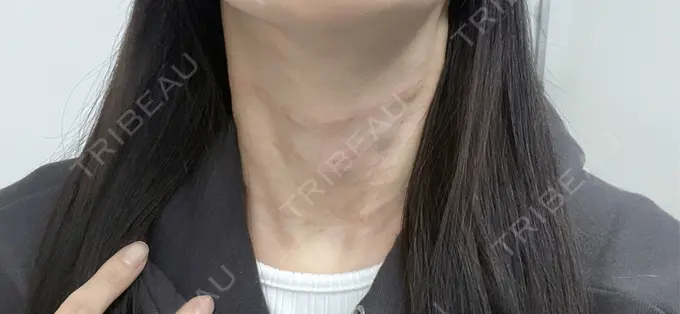 ヒアルロン酸注入（首） 銀座TSUBAKIクリニック DAY 0 メイン用