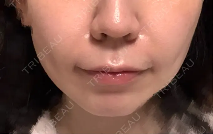 ヒアルロン酸注入（鼻翼基部） Brandnew Beauty Clinic DAY 5 メイン用