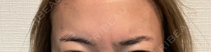 ボトックス（あご） / ボトックス（口角） / ボトックス（眉間） / ボトックス（目尻） / ボトックス（額） / ボトックス（人中） / ボトックス（ガミースマイル） DMTC CLINIC 渋谷院 AFTER メイン用