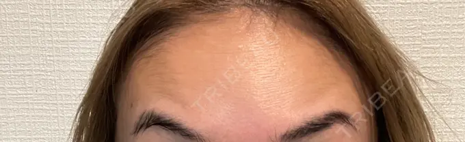 ボトックス（あご） / ボトックス（口角） / ボトックス（眉間） / ボトックス（目尻） / ボトックス（額） / ボトックス（人中） / ボトックス（ガミースマイル） DMTC CLINIC 渋谷院 DAY 6 メイン用