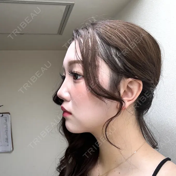 クマ治療 / 脂肪吸引（顔） / ヒアルロン酸注入（涙袋） / ヒアルロン酸注入（目の下） ネビュラクリニック 東京錦糸町院 DAY 8 メイン用