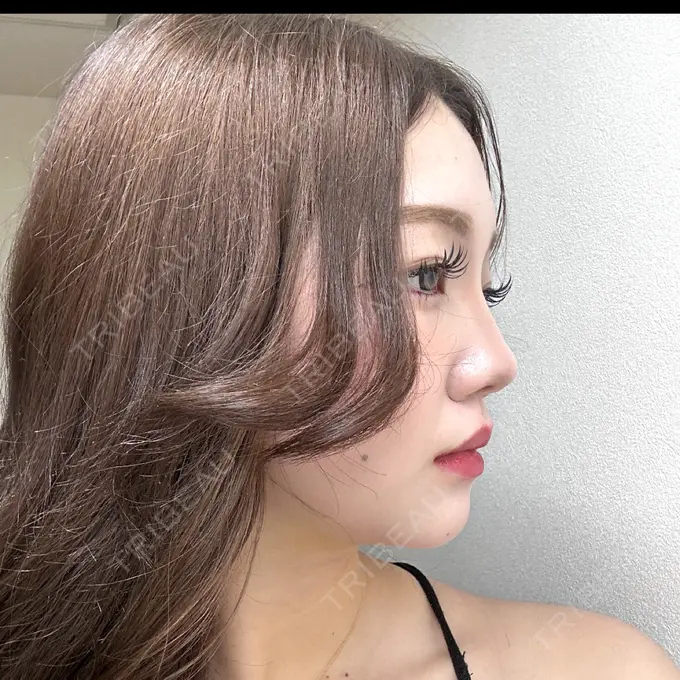 クマ治療 / 脂肪吸引（顔） / ヒアルロン酸注入（涙袋） / ヒアルロン酸注入（目の下） ネビュラクリニック 東京錦糸町院 DAY 8 メイン用