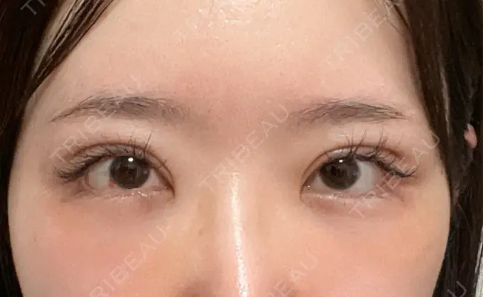 クマ治療 / 下まぶたの脂肪取り / 脂肪注入（目の下） ルラ美容クリニック 渋谷本院 DAY 8 メイン用