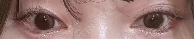 目尻切開 / タレ目形成・グラマラスライン（埋没） LOUIS CLINIC 二子玉川院【ルイクリニック】 DAY 9 メイン用