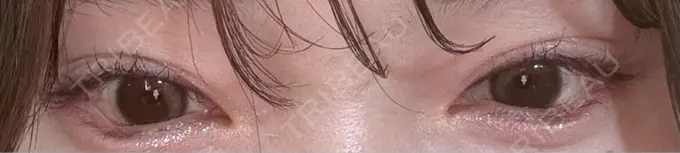 目尻切開 / タレ目形成・グラマラスライン（埋没） LOUIS CLINIC 二子玉川院【ルイクリニック】 DAY 9 メイン用