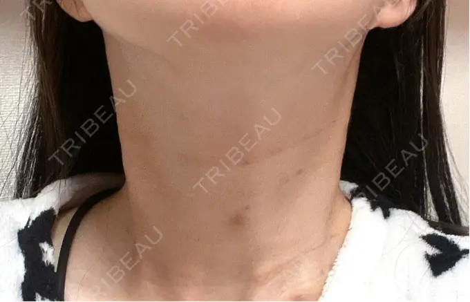 ヒアルロン酸注入（首） 銀座TSUBAKIクリニック DAY 1 メイン用