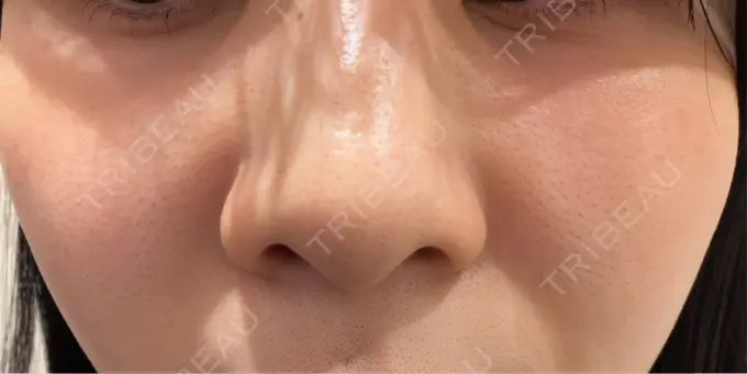 肌育注射（ジュベルックなど） 城本クリニック 名古屋院 AFTER メイン用