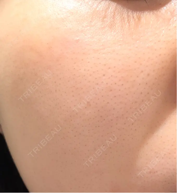 肌育注射（ジュベルックなど） 城本クリニック 名古屋院 DAY 23 メイン用