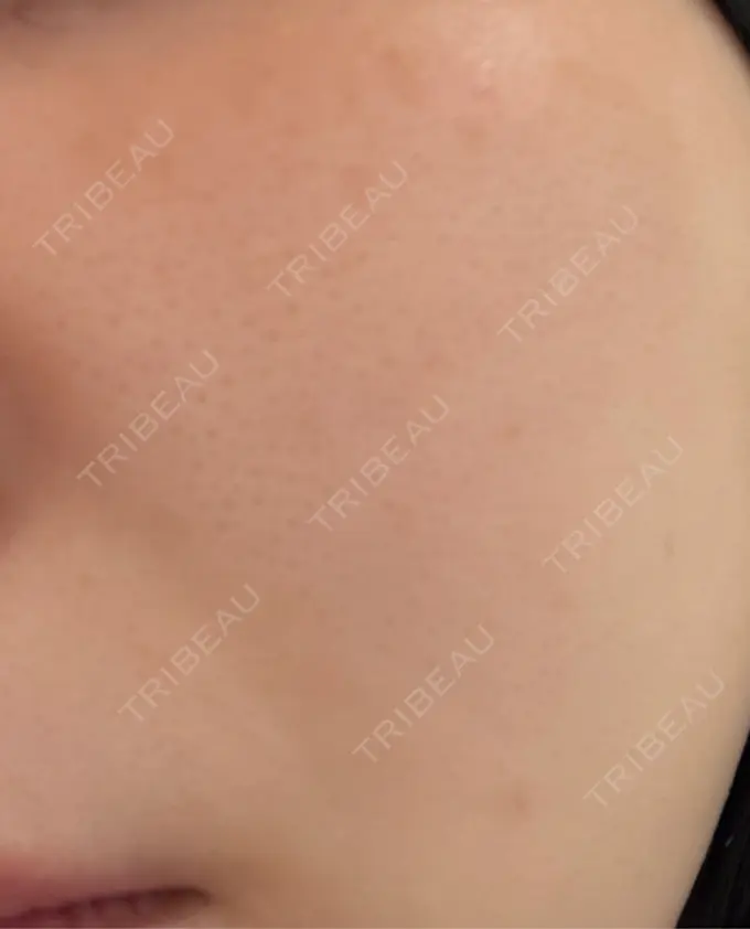 肌育注射（ジュベルックなど） 城本クリニック 名古屋院 DAY 23 メイン用