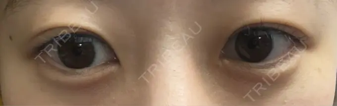 ヒアルロン酸注入（涙袋） フィラークリニック 名古屋栄院 DAY 0 メイン用