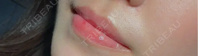 ヒアルロン酸注入（涙袋） / ヒアルロン酸注入（唇） アリエル美容クリニック 横浜院 AFTER メイン用