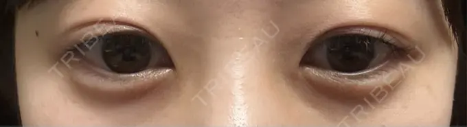 ヒアルロン酸注入（涙袋） フィラークリニック 名古屋栄院 DAY 1 メイン用