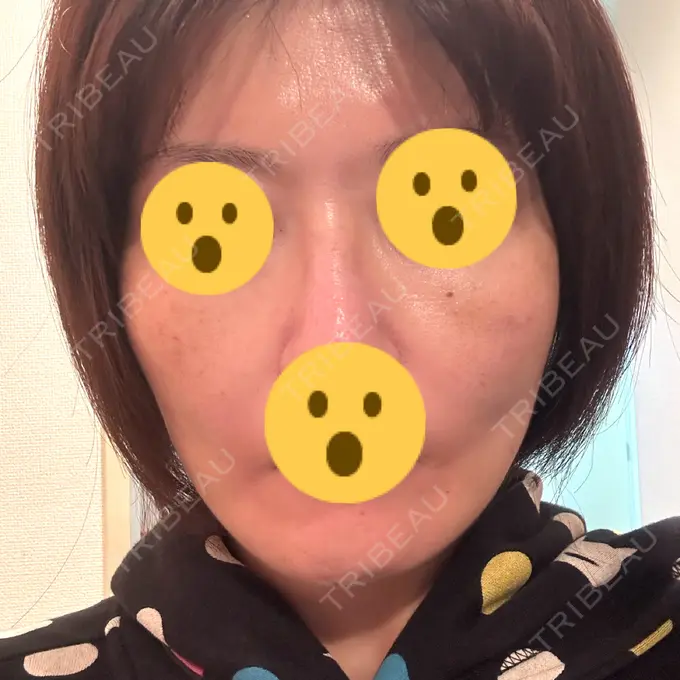 糸リフト SK新宿歌舞伎町美容外科・歯科 AFTER メイン用