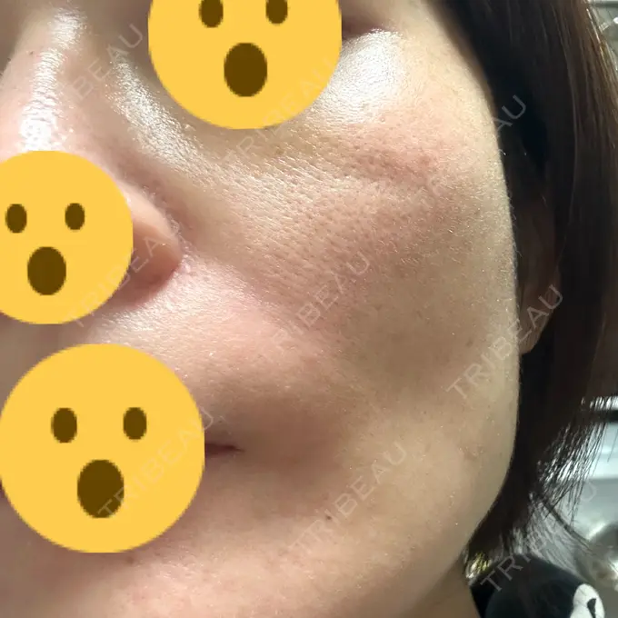 糸リフト SK新宿歌舞伎町美容外科・歯科 DAY 12 メイン用