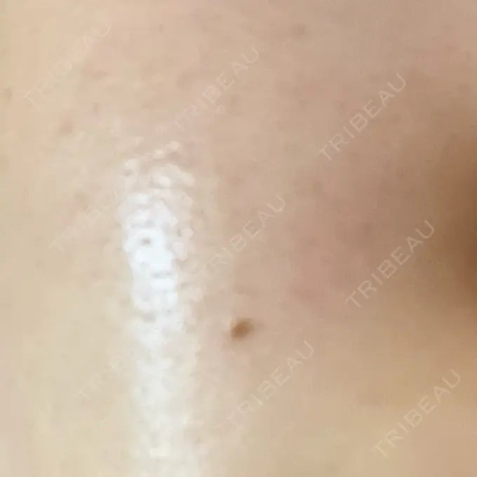 ルメッカ 大美会クリニック 岡山院 AFTER メイン用