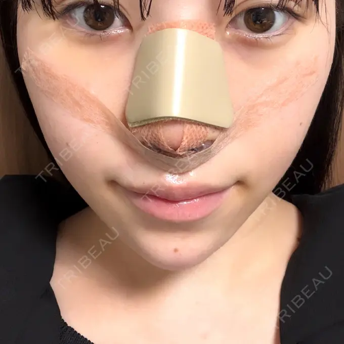 隆鼻術 / 軟骨移植 / 鼻尖形成（非切開） / 鼻中隔延長（非切開） WOM CLINIC GINZA （ワム クリニック ギンザ） DAY 7 メイン用