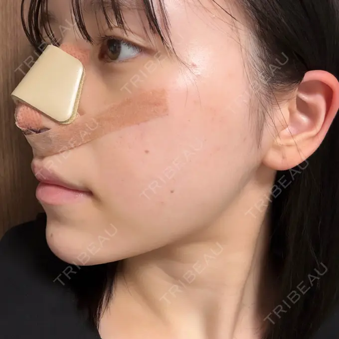 隆鼻術 / 軟骨移植 / 鼻尖形成（非切開） / 鼻中隔延長（非切開） WOM CLINIC GINZA （ワム クリニック ギンザ） DAY 7 メイン用